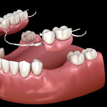 3D illustration for partial dentures