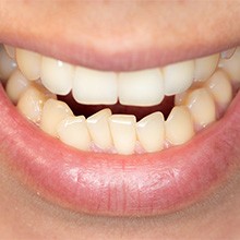 Close-up of mouth with crowded teeth in the lower arch