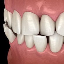 Illustration of a crossbite involving the front bottom teeth