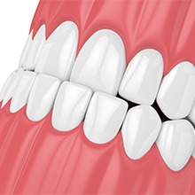 Illustration of front view of underbite