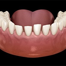 Illustration of gaps between teeth in lower arch