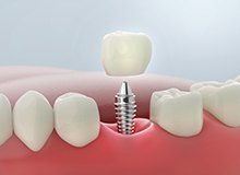 Illustration of dental implant and crown being inserted into gums