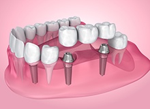 Illustration of dental bridge and two dental implants in jaw