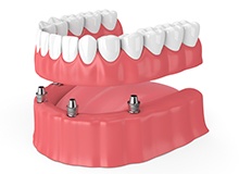 Illustration of dentures being attached to dental implants