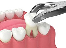 Illustration of tooth being extracted with forceps